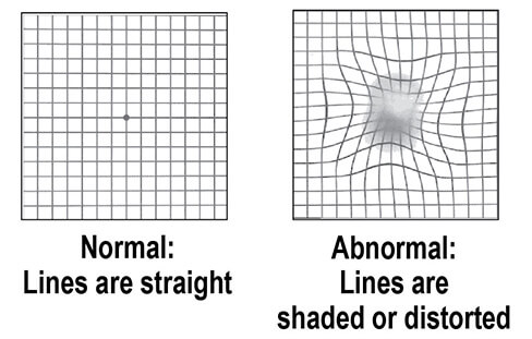 Two grids, one normal with straight lines, and one abnormal with shaded or distorted lines.