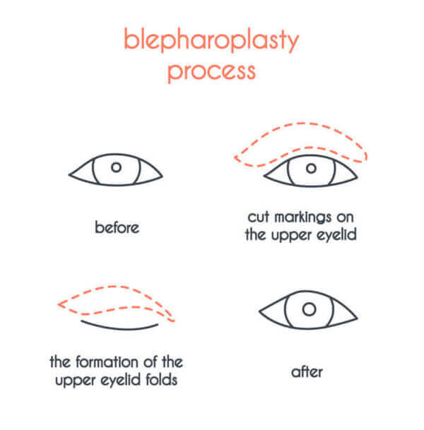 Chart Illustrating the Blepharoplasty Process