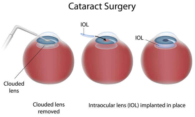 Chart Illustrating the Cataract Surgery Procedure