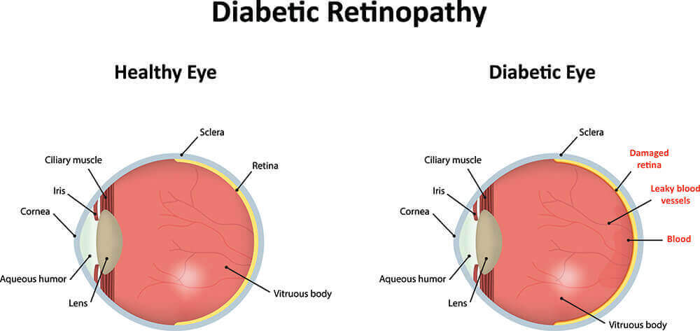 Chart Illustrating a Healthy Eye Compared to One With Diabetic Retinopathy