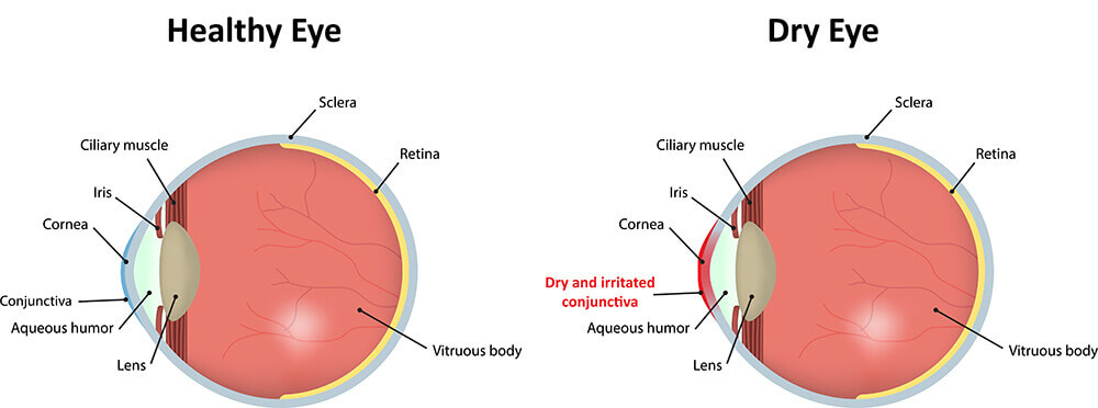 Chart Illustrating a Healthy Eye Vs One Experiencing Dry Eye