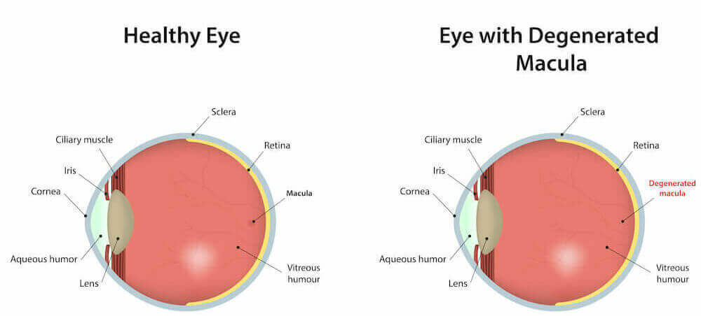 Chart Illustrating a Healthy Eye Compared to One With Macular Degeneration