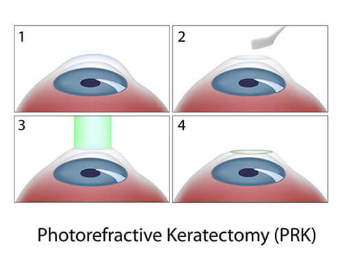 Chart Illustrating the PRK Surgery Process