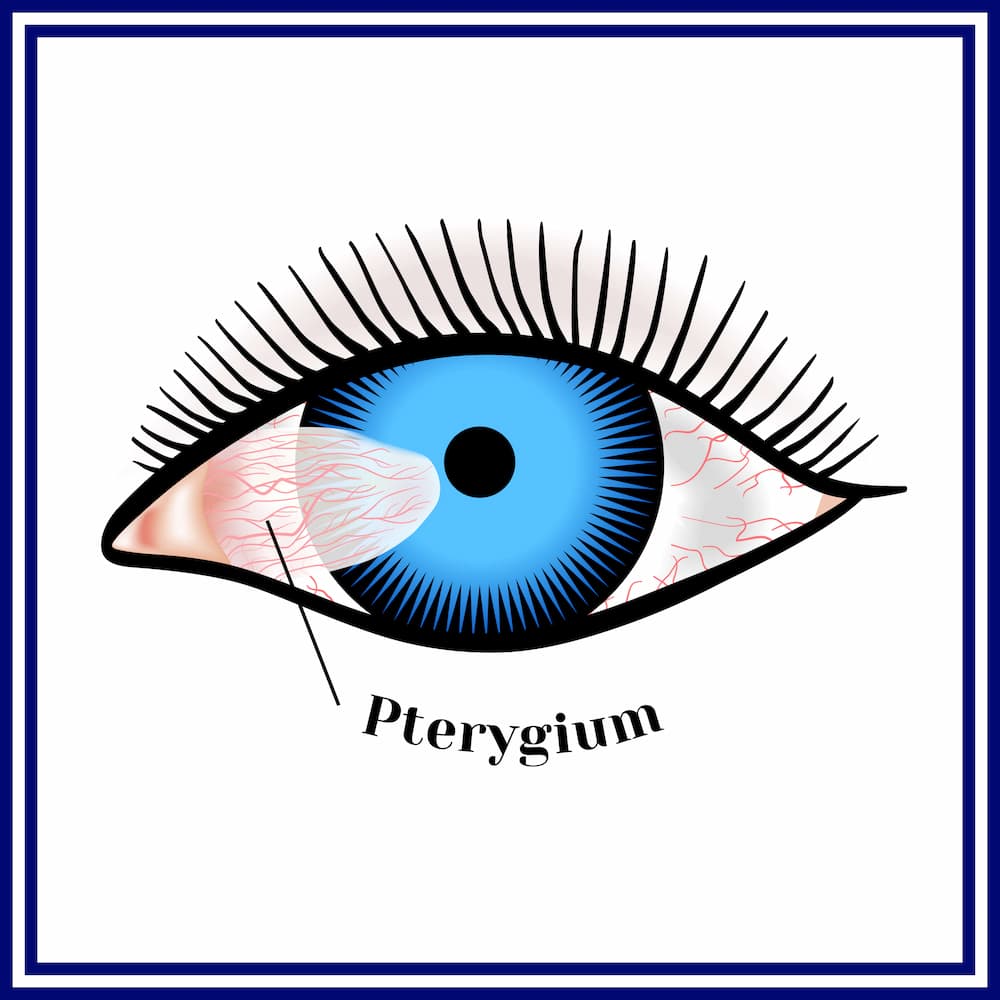 Graphic of Pterygium growth covering the eye